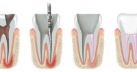 lechenie-kanalov-zuba