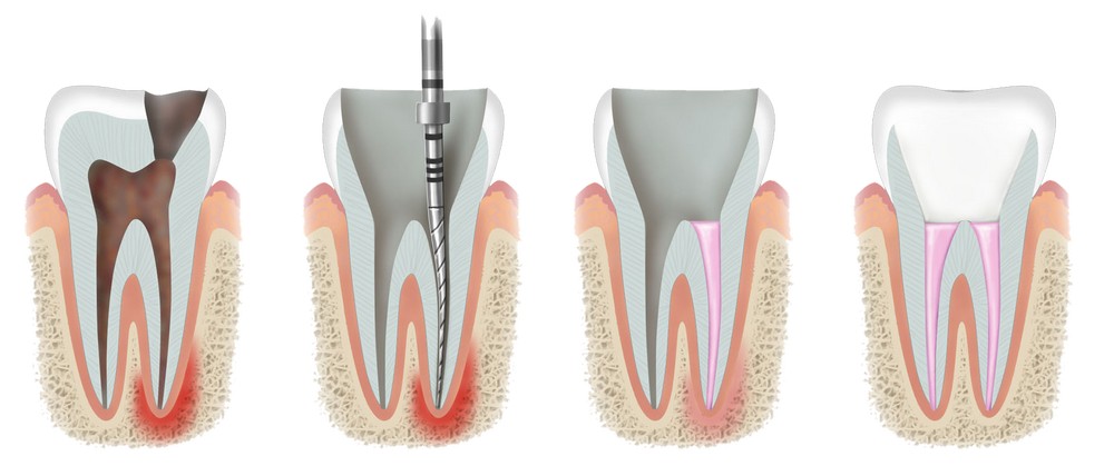 lechenie-kanalov-zuba