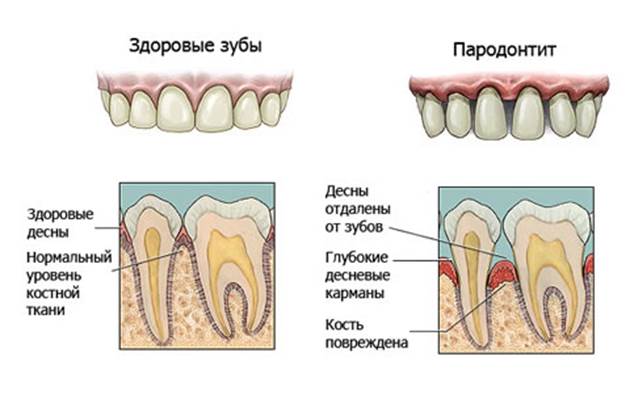 Лечение пародонтита Томск Сельская томск стоматология жемчуг